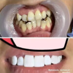 6 Cara Memutihkan Gigi: Tips dan Trik yang Efektif